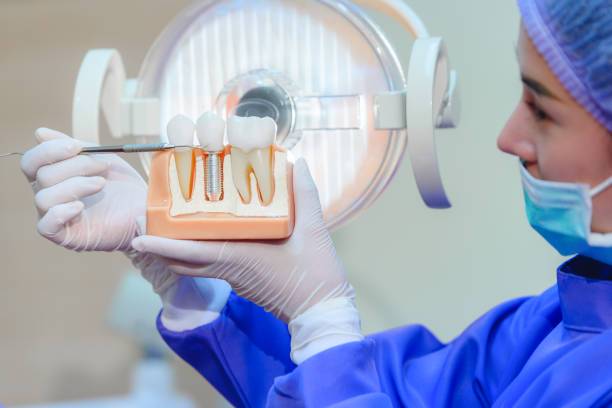 implantes-dentales-el-mejor-momento-para-colocarlos imagen de artículo