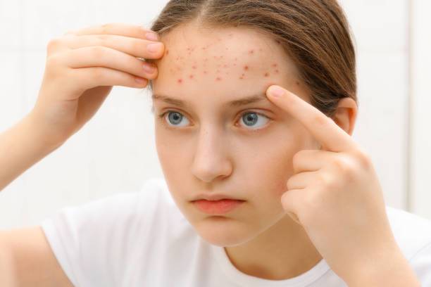 acne-causas-factores-de-riesgo-y-claves-para-su-tratamiento-efectivo imagen de artículo