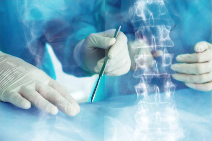 cirugia-columna-minimamente-invasiva-que-es-beneficios-cuando-se-indica imagen de artículo