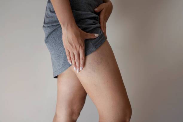 varices-por-que-vuelven-como-tratarlas-y-cuando-operarlas imagen de artículo