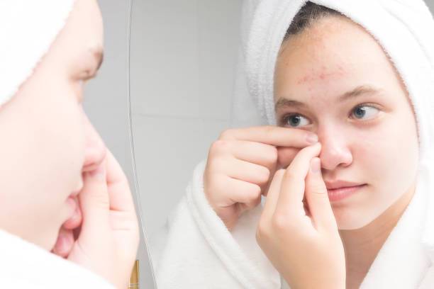 cicatrices-de-acne-que-no-mejoran-con-nada imagen de artículo