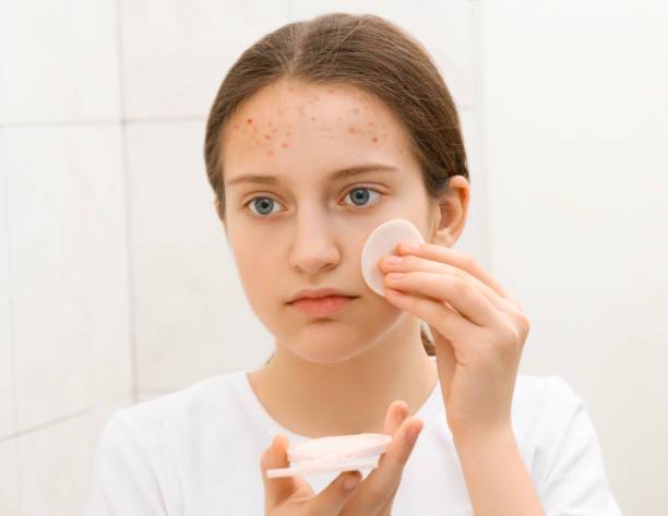 la-verdad-sobre-el-acne-juvenil-un-enfoque-completo imagen de artículo