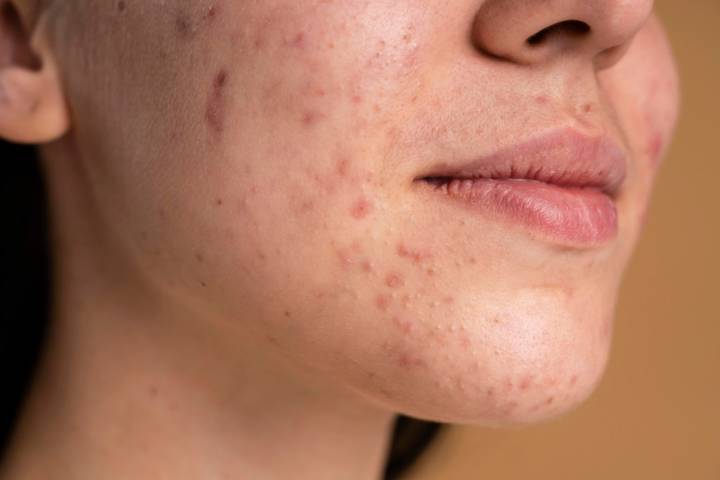 acne-causas-sintomas-y-tratamientos-actuales imagen de artículo