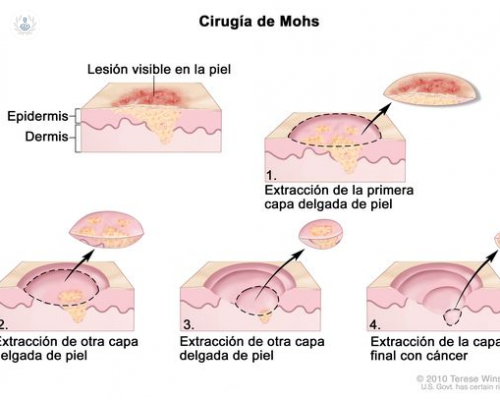 Microcirugía de Mohs
