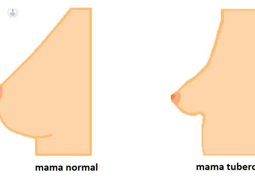 mamas-tuberosas imagen de artículo