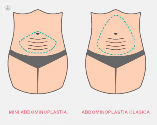 abdominoplastia-o-lipectomia-de-abdomen imagen de artículo