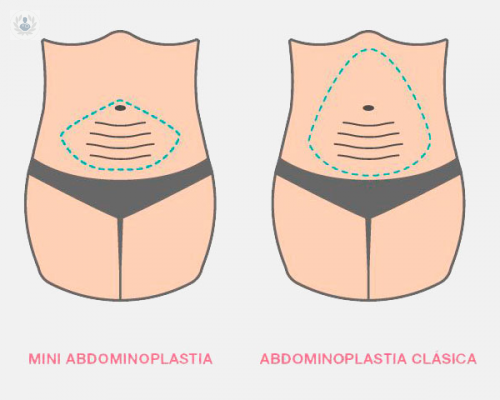 Abdominoplastia o Lipectomía de Abdomen