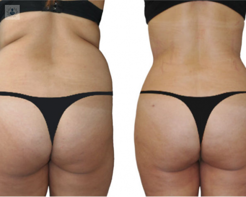 liposuccion-por-aspiracion imagen de artículo