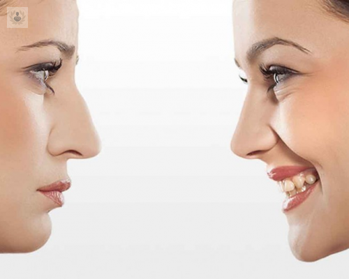 cirugia-de-la-nariz-rinoplastia imagen de artículo