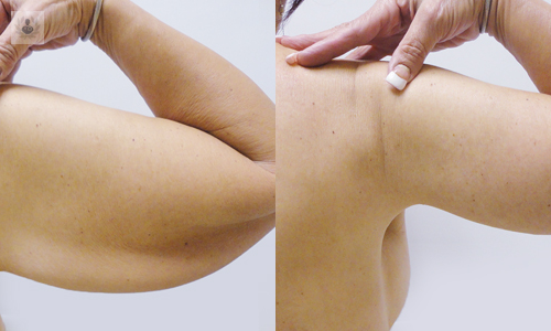 lifing-de-brazos-braquioplastia imagen de artículo