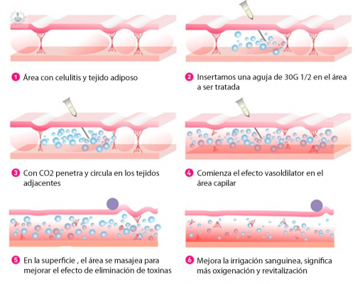la-carboxiterapia-para-combatir-la-celulitis-el-exceso-de-grasa-y-envejecimiento-facial imagen de artículo