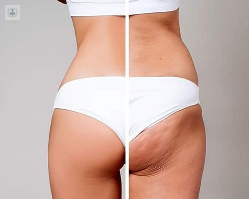 tratamiento-de-la-celulitis imagen de artículo