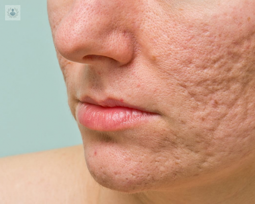 Treatment of acne scars