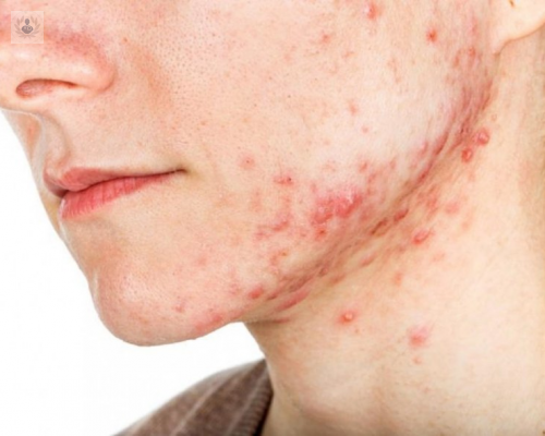 tratamiento-del-acne imagen de artículo