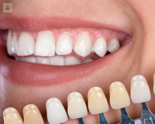 recubrimiento-de-dientes-con-carillas-o-coronas imagen de artículo