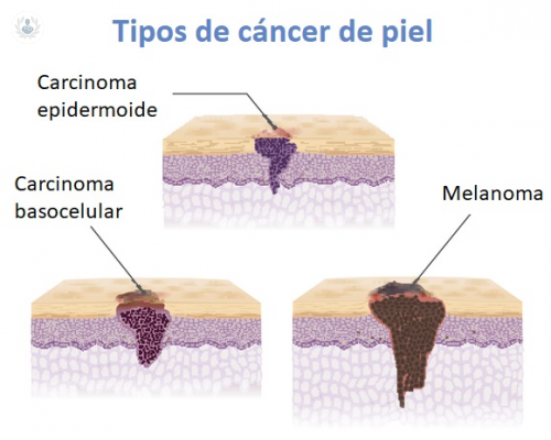 Tratamiento del Cáncer de Piel (Carcinoma, Melanoma) sin cirugía