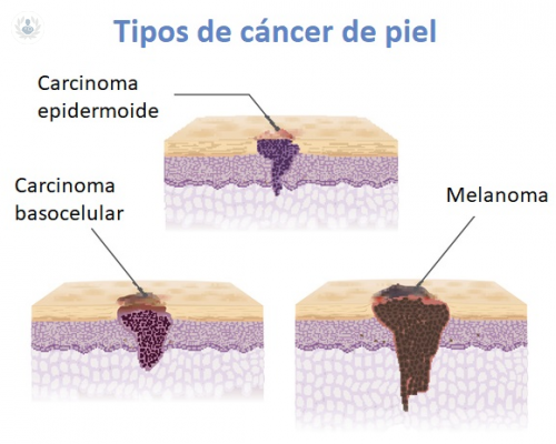 tratamiento-del-cancer-de-piel-carcinoma-melanoma-sin-cirugia imagen de artículo
