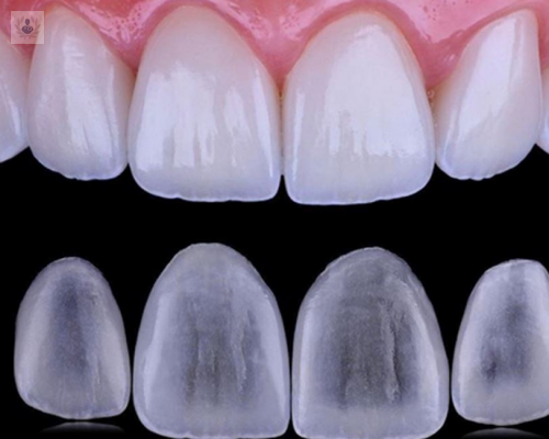 tratamiento-de-la-sonrisa-con-carillas-de-composite imagen de artículo