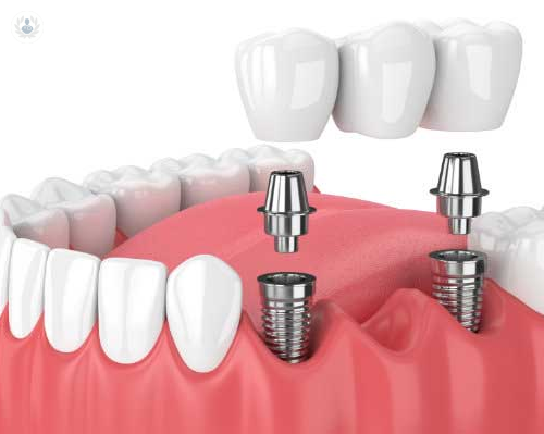 Implantes Dentales de Carga Inmediata
