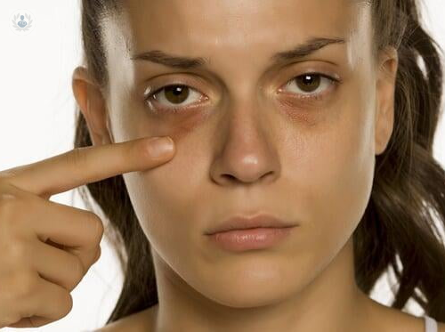 eliminar-las-ojeras-es-posible-en-una-o-dos-sesiones imagen de artículo