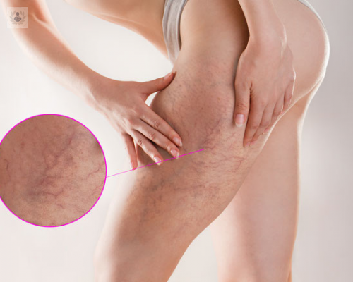 Remove leg veins or spider veins of the legs is possible by laser