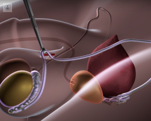 vasectomia-sin-bisturi-y-sin-agujas-una-tecnica-innovadora-y-sin-dolor imagen de artículo