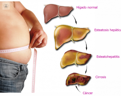 higado-graso-como-prevenirlo imagen de artículo