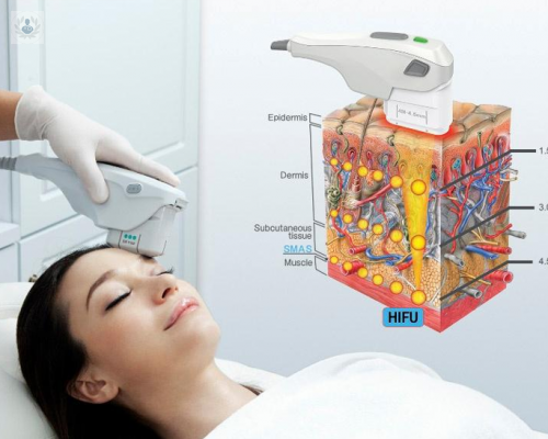 efecto-lifting-sin-cirugia-conoces-los-ultrasonidos-focalizados imagen de artículo