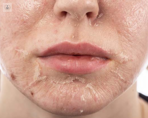 el-peeling-tecnica-para-eliminar-manchas-y-cicatrices-de-la-piel imagen de artículo