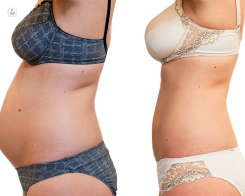 Stop the fat and skin of the belly with a tuck