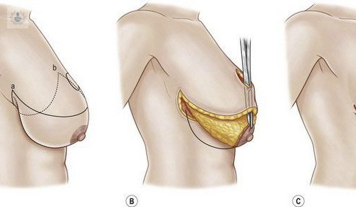 elevar-y-cambiar-la-forma-del-pecho-es-posible-con-una-mastopexia imagen de artículo