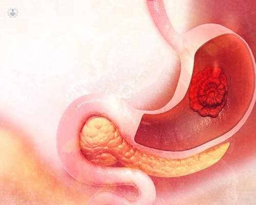 causas-y-prevencion-del-cancer-de-estomago imagen de artículo