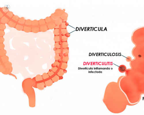 los-diverticulos-de-colon-que-son-y-como-se-previenen imagen de artículo