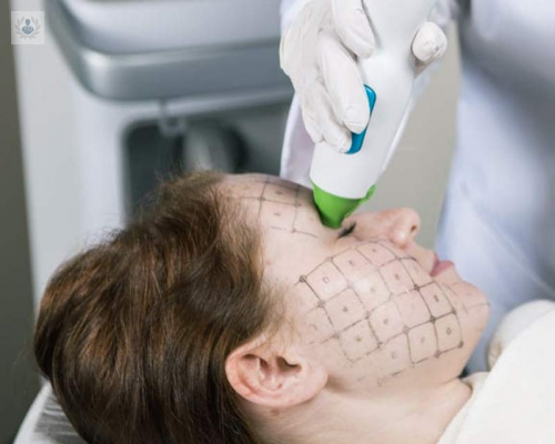 thermage-cpt-system imagen de artículo