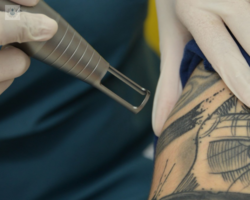 eliminar-manchas-y-tatuajes-con-laser imagen de artículo