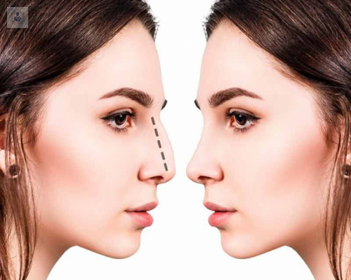 el-procedimiento-de-una-rinoplastia imagen de artículo
