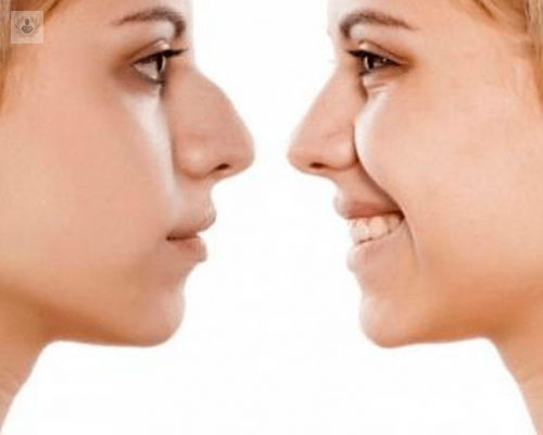 operaciones-de-nariz-y-retoques-sin-cirugia imagen de artículo