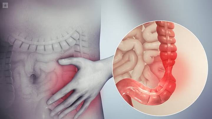 el-sindrome-del-intestino-irritable-o-colon-irritable imagen de artículo