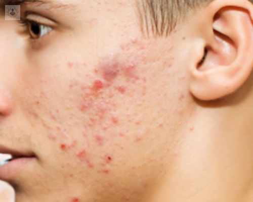 la-influencia-de-la-dieta-en-el-acne imagen de artículo