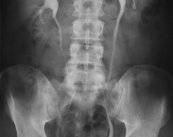 la-litiasis-renal-o-piedras-en-los-rinones imagen de artículo
