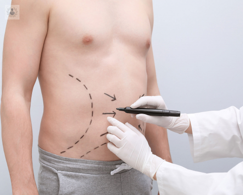 el-lipolaser-y-sus-ventajas-frente-a-los-metodos-tradicionales imagen de artículo