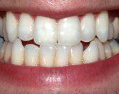 cirugia-osea-piezoelectrica-una-nueva-tecnica-minimamente-invasiva imagen de artículo