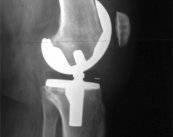 nuevas-perspectivas-en-las-lesiones-menisco-ligamentosas-de-la-rodilla imagen de artículo