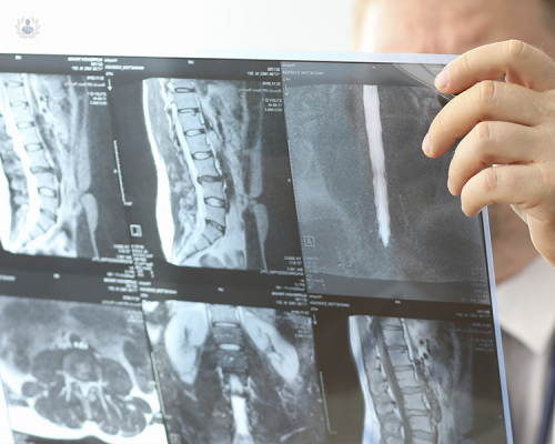 hernia-discal-lumbar-y-ciatica imagen de artículo