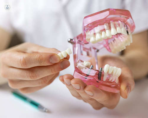 Implantes Dentales, una solución eficaz para tu sonrisa