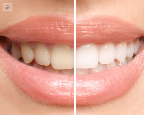 El Blanqueamiento Dental ayuda a eliminar las manchas superficiales