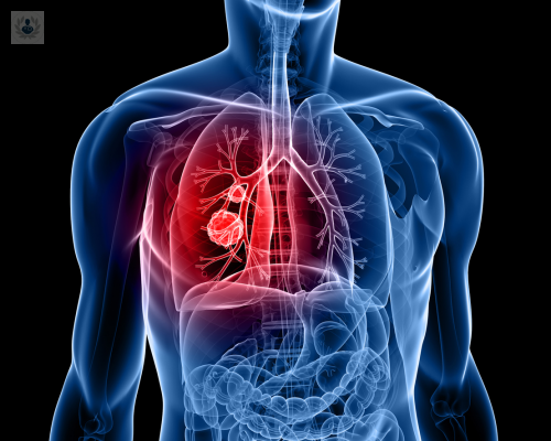 El Nódulo Pulmonar, el diagnóstico y sus causas 
