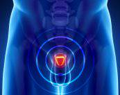 La Braquiterapia, una radiación que combate el Cáncer de Próstata desde dentro