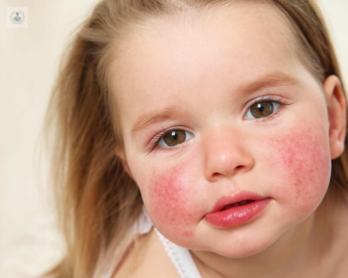 dermatitis-atopica-el-asma-de-la-piel imagen de artículo