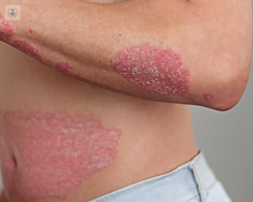 psoriasis-tipos-y-tratamientos imagen de artículo